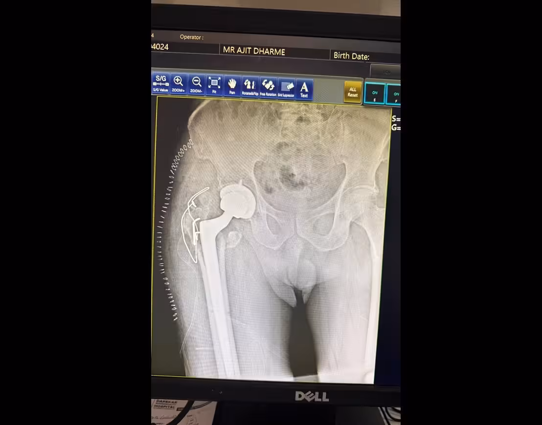 Robotic-assisted hip replacement surgery in Pune